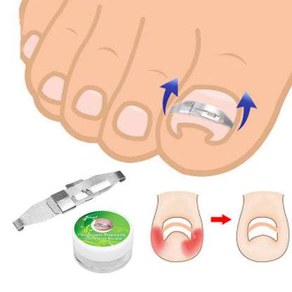 AMONIDA Stainless Steel Ingrown Toenail Corrector  Paronychia Treatment Correcting Tool,Ingrown Toenail Corrector,Paronychia Treatment Tool
